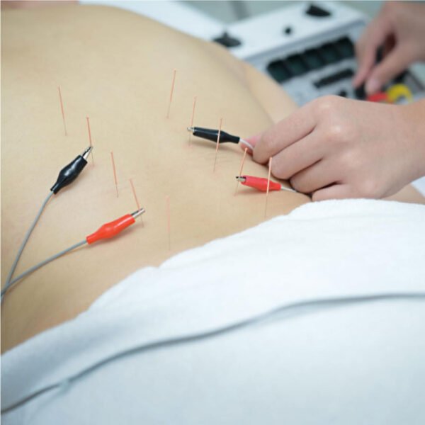 acupuntura