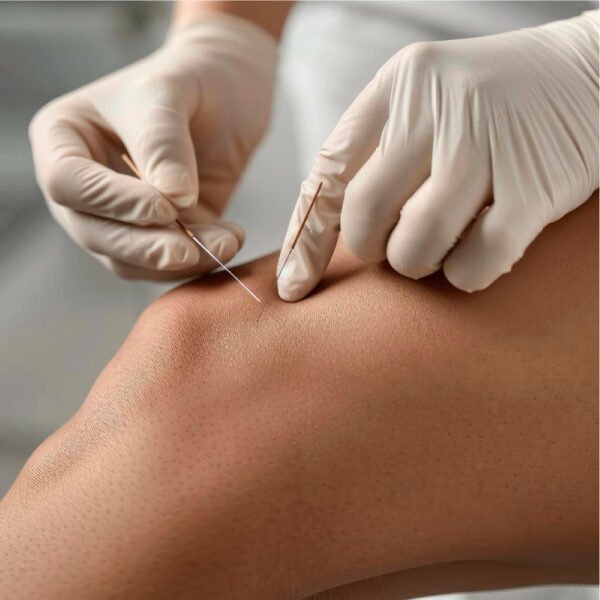 dry needling