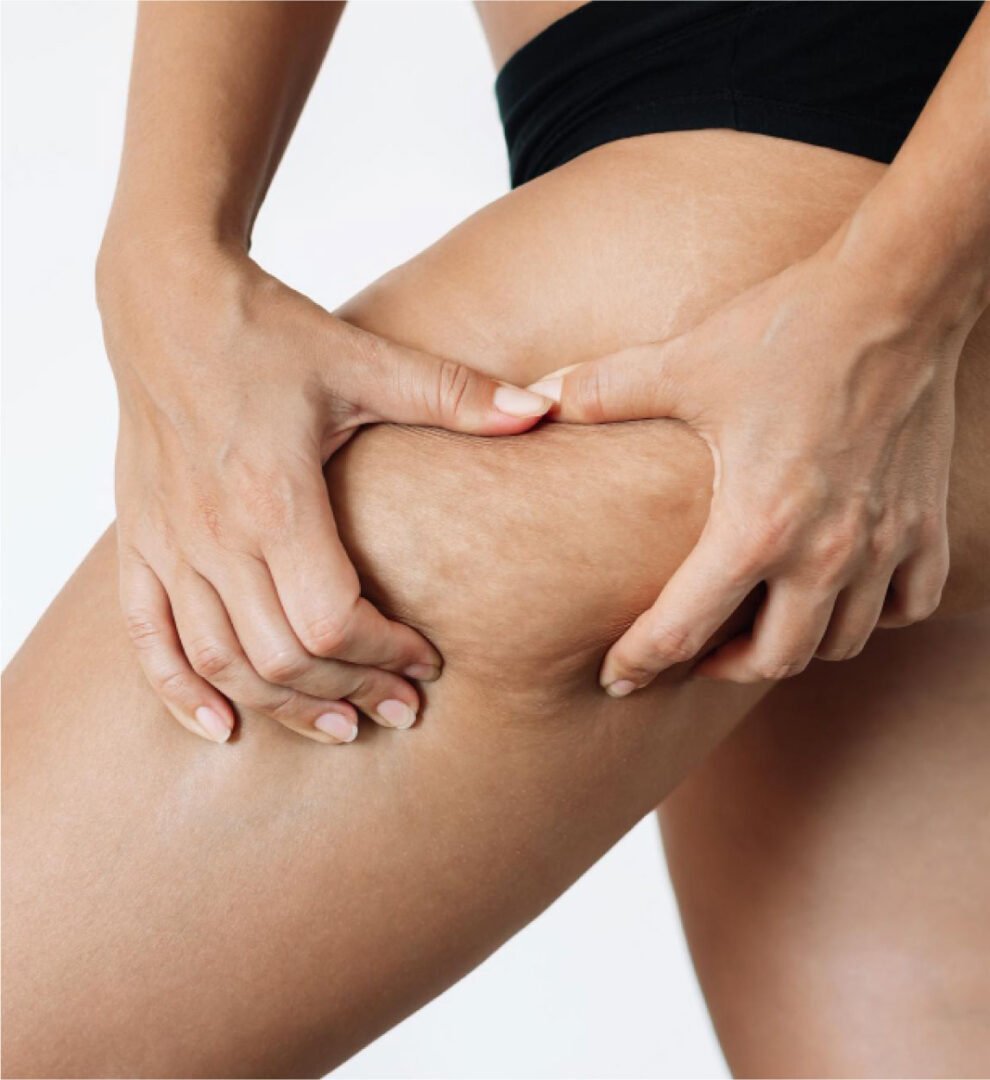 mesoterapia estetica celulite
