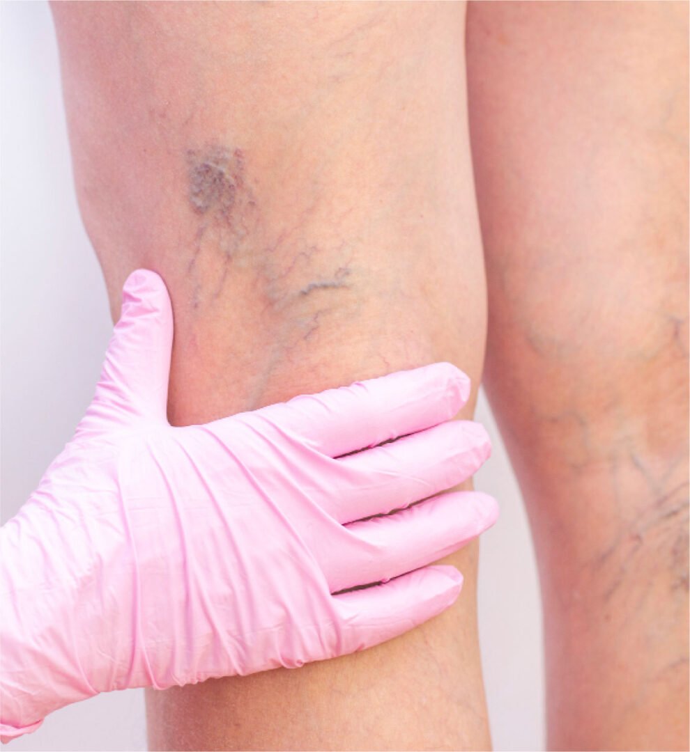 mesoterapia vascular derrames varizes